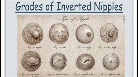 Article: Newly Inverted Nipples: What Are the。